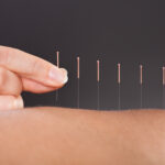 Acupuncture 150x150