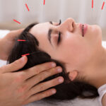 Facial Acupuncture 150x150