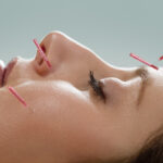 Facial Acupuncture 2 150x150