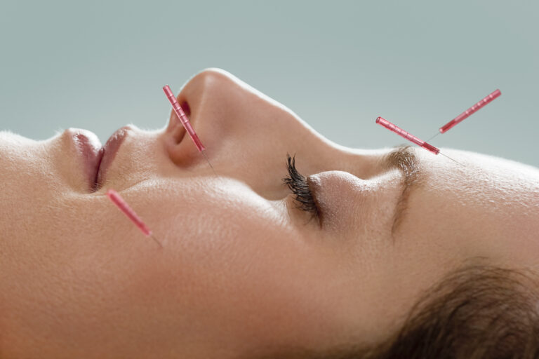 Facial Acupuncture 2 768x512